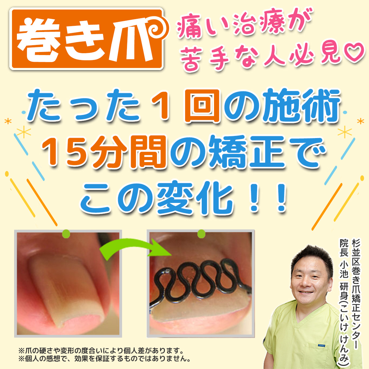 西東京市｜巻き爪矯正治療ツメフラ法とは