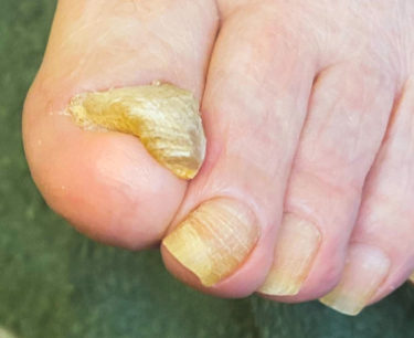 足の爪が厚い、変色する…その原因は「肥厚爪」かも！