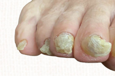 肥厚爪とは？特徴・原因・治し方などを解説