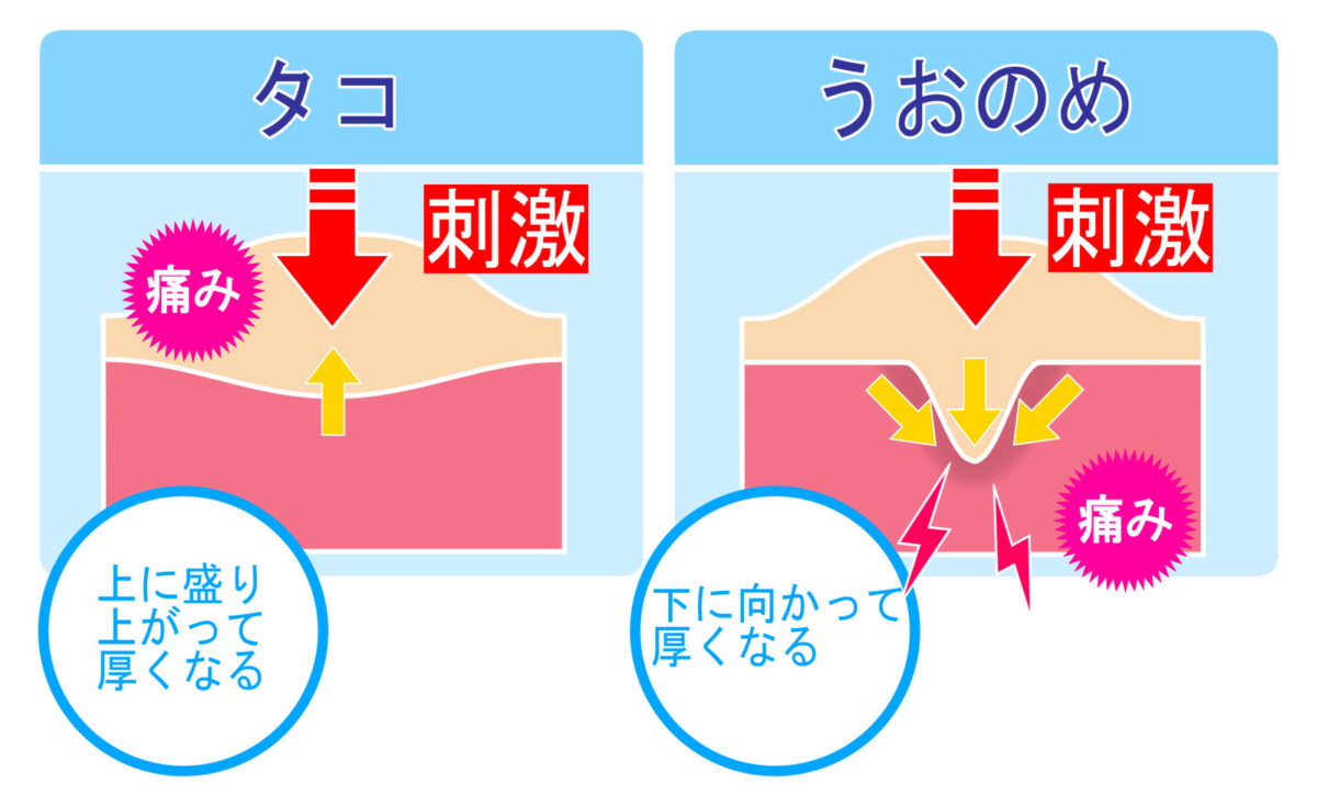 繰り返す巻き爪の原因はケラチンの蓄積！ツメフラ法で再発防止 | 東京巻き爪治療 専門情報＆サロン
