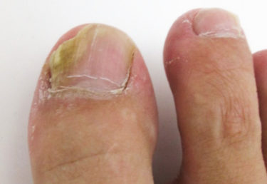 足の爪が厚い、白や黄色に変色する…その原因は「爪白癬」かも！